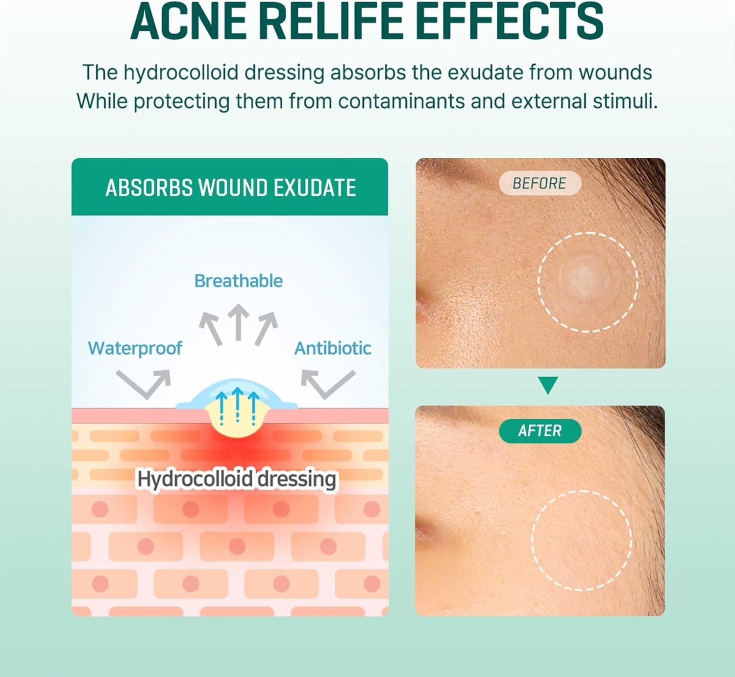 SOME BY MI Miracle Acne Removal Patches 18 pieces - Image 3