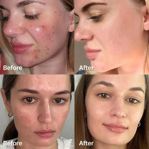 Medicube Red Succinic Acid Acne Serum, 30ml - الصورة 3